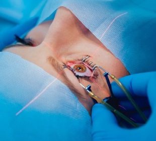LASIK Eye Surgery