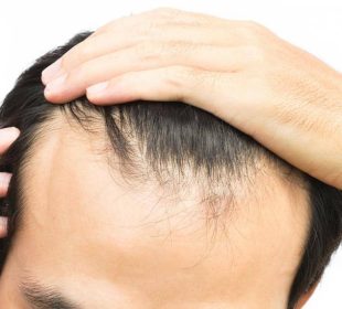 Minoxidil Question