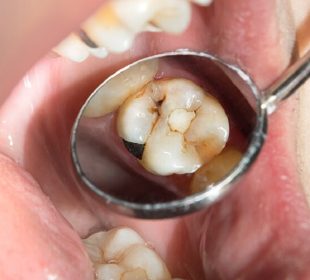 Tooth Decay Before Teeth Whitening