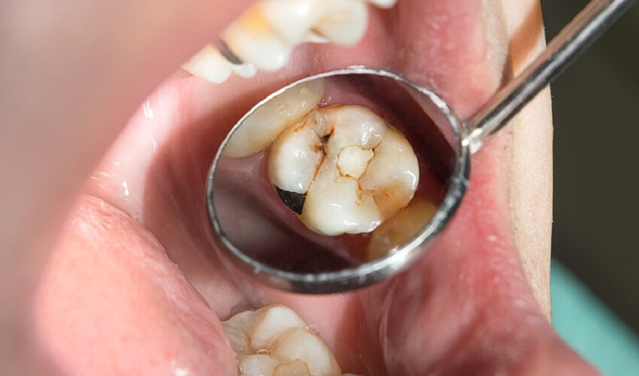 Tooth Decay Before Teeth Whitening