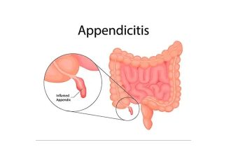 Appendicitis