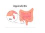 Appendicitis