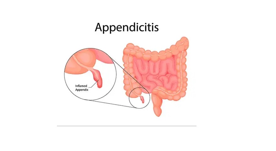 Appendicitis